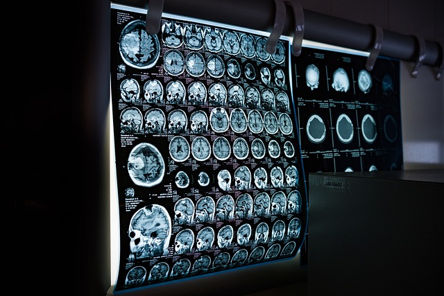 Jak wygląda tomografia komputerowa kręgosłupa lędźwiowego?